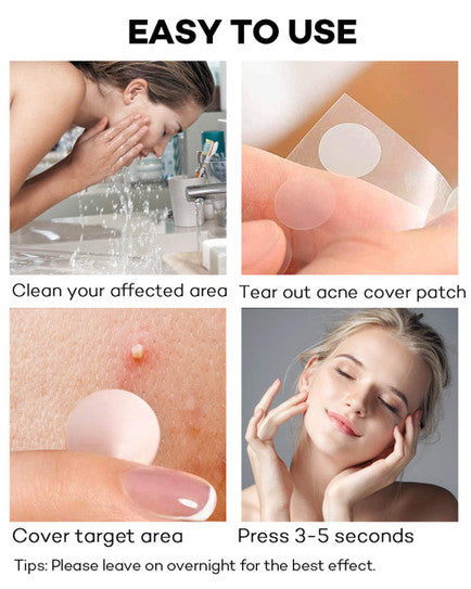 Mesoderm Intensive Acne Patch - Mesoderm | Targets Blemishes for Clearer Skin
