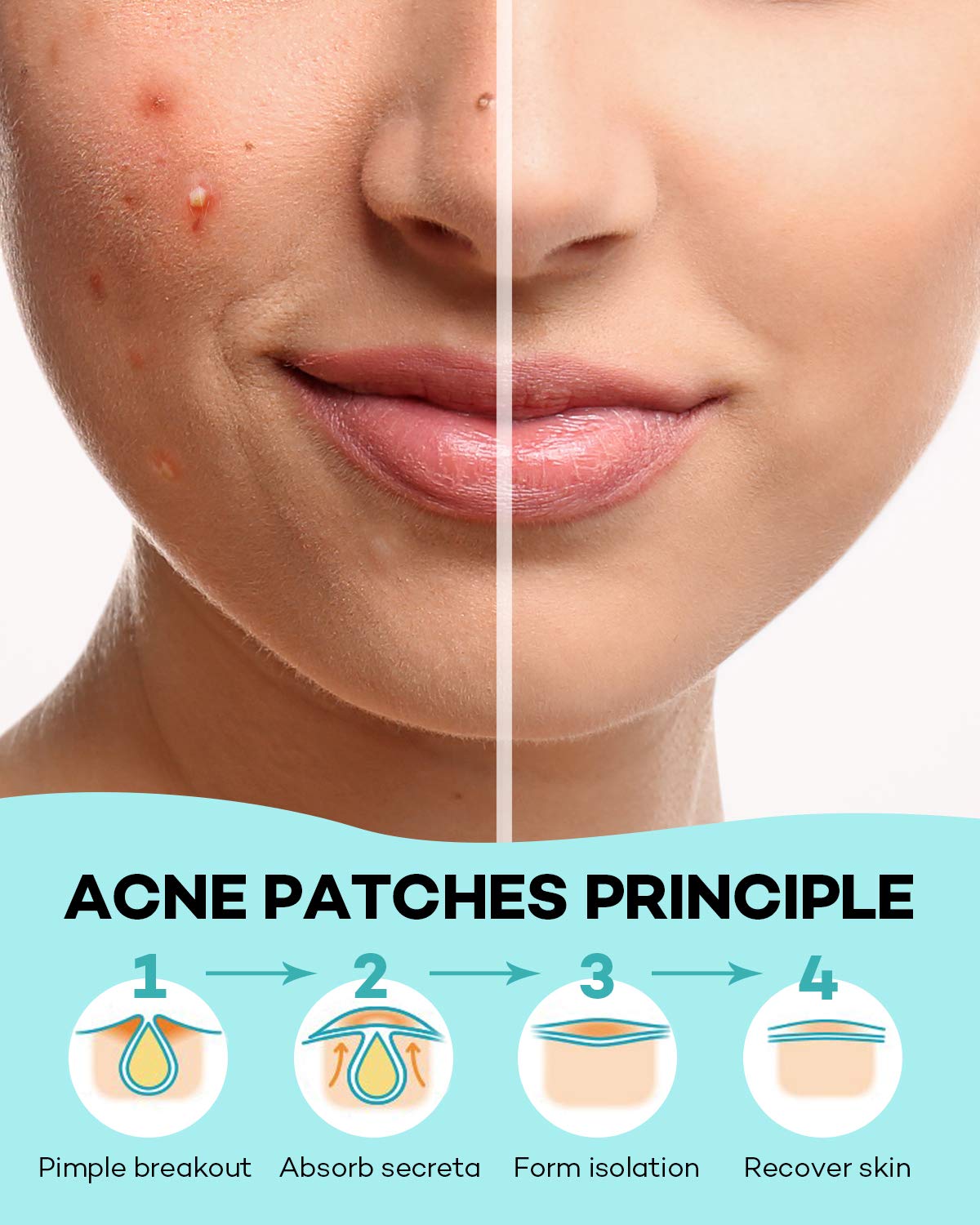 Acne Intensive Patch - Mesoderm RX | Targets Blemishes for Clear Skin